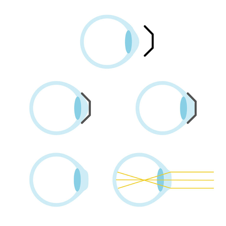 Veranschaulichung der Funktionsweise von Ortho-K Linsen in Form von Augen